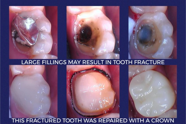 Before and after smile at Portola Smiles