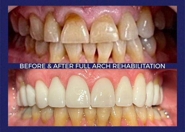 Before and after smile at Portola Smiles