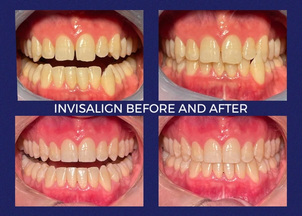 Before and after smile at Portola Smiles