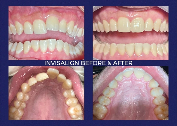 Before and after smile at Portola Smiles