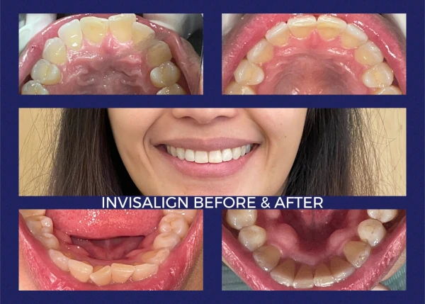 Before and after smile at Portola Smiles