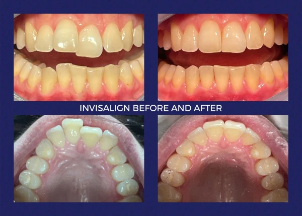 Before and after smile at Portola Smiles