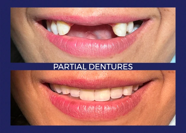 Before and after smile at Portola Smiles