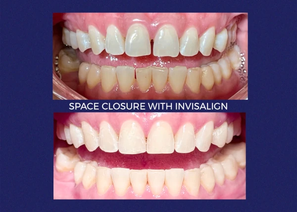 Before and after smile at Portola Smiles