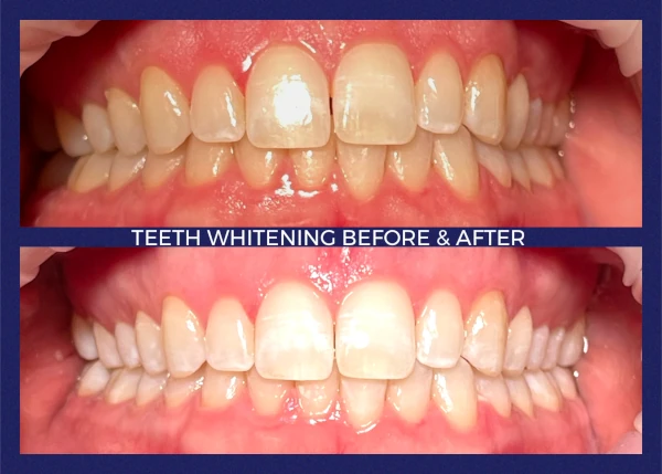 Before and after smile at Portola Smiles