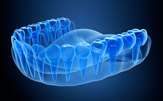 xray view of multiple implants