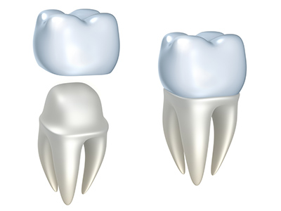 Dental Crowns at Portola Smiles