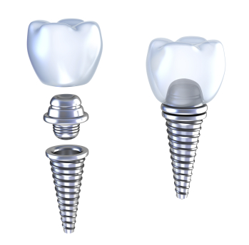Dental Implants at Portola Smiles