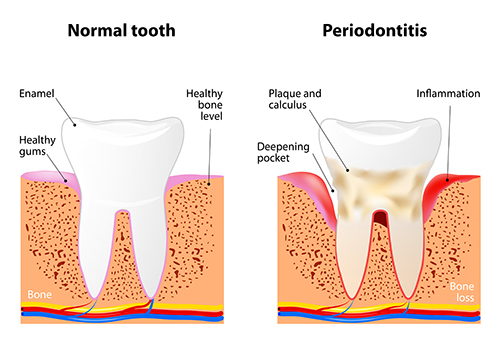 Periodontal Disease Diagram